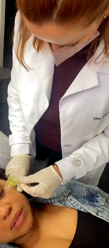 Foto de uma paciente com o procedimento de Fios de PDO aplicados na face pela Dra. Juliana Guedes